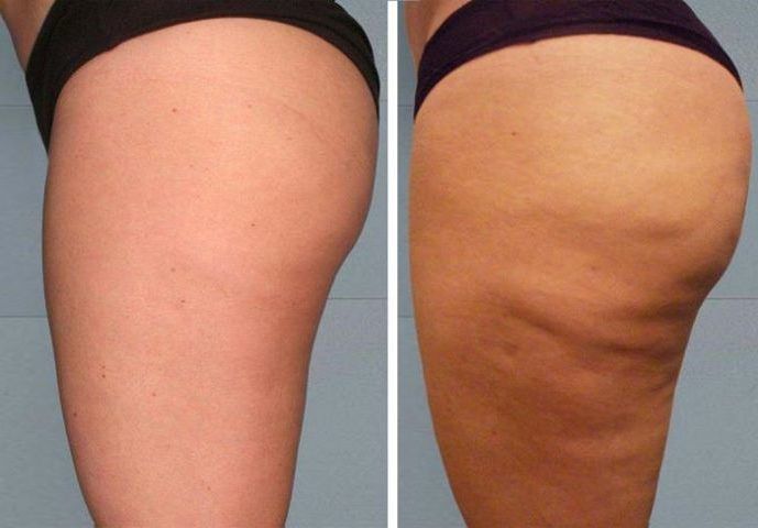 Mesoterapia corporal en oviedo antes y después